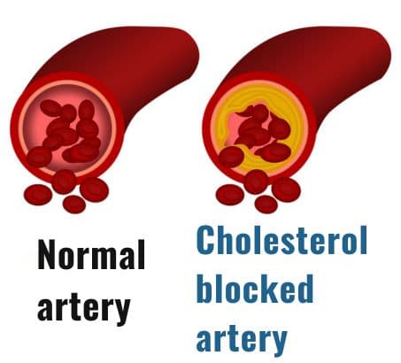 cross section of normal arteries and arteries blocked by cholesterol