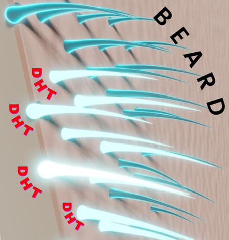 DHT receptors shown in hair follicle area. Strands with dht shown as bright and strong