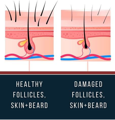 Healthy vs. damaged skin crucial for beard growth. Beware of harmful personal care products.