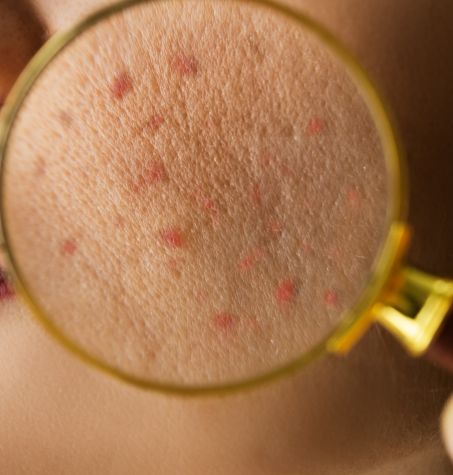 Close of irritated skin: bumps and redness