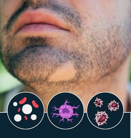 a man with a light beard with patches of baldness in the beard area, symbolizing the effects of autoimmune disorder issues