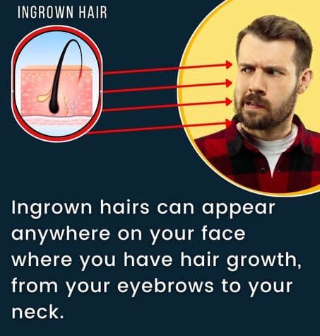 a man wincing as arrows point to parts of his face where ingrown hairs can appear, from eyebrows to neck