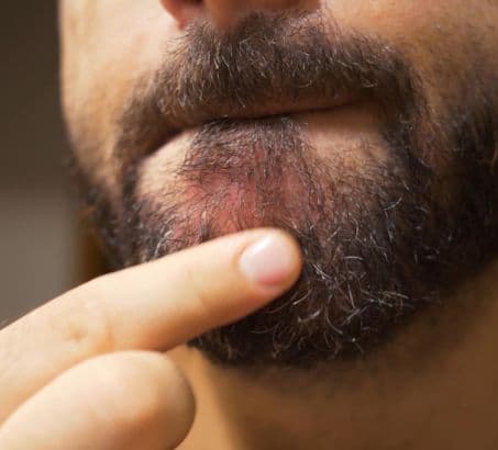 man pointing to beard covering skin blemishes