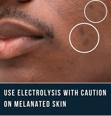 close up of young melanated man with hyper pigmentation burns from electrolysis hair removal