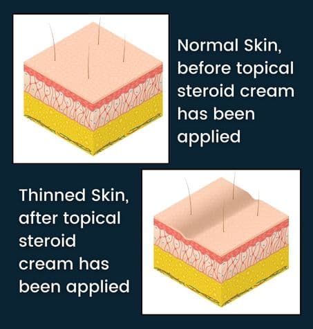 comparison skin illustrations. Normal Skin before topical steroid cream versus thinned skin after topical steroid cream