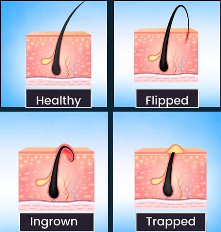 collage depticting lifecycle of ingrown beard hair strand