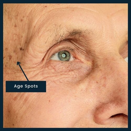 showing close up of face of mature man with age spots and liver spots near his eyes