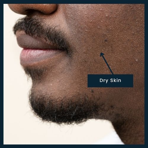 showing close up of face with dry skin
