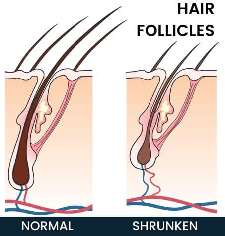 showing the effects of DHT on scalp hair follicles normal v shrunken follicles