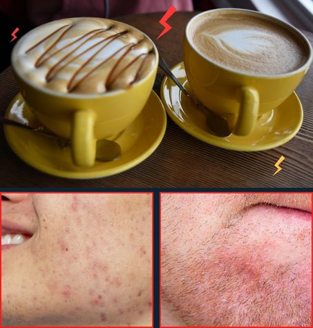 comparison: sugary foods and milk on one side, and negative effects like inflammation, acne, and clogged pores on the other side