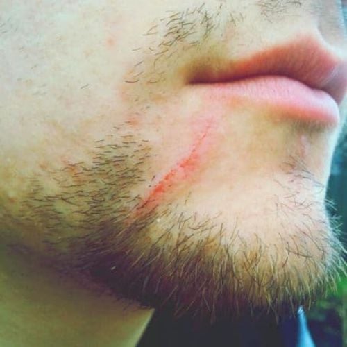 close up of a young man grazed scar in beard area