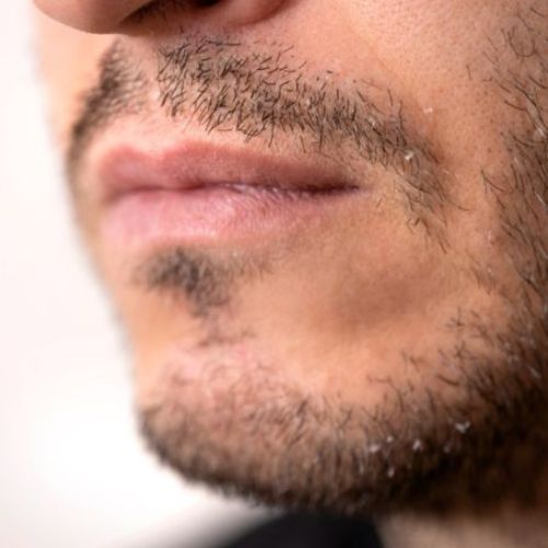 close up of man with flakes of dry skin on moustache and beard