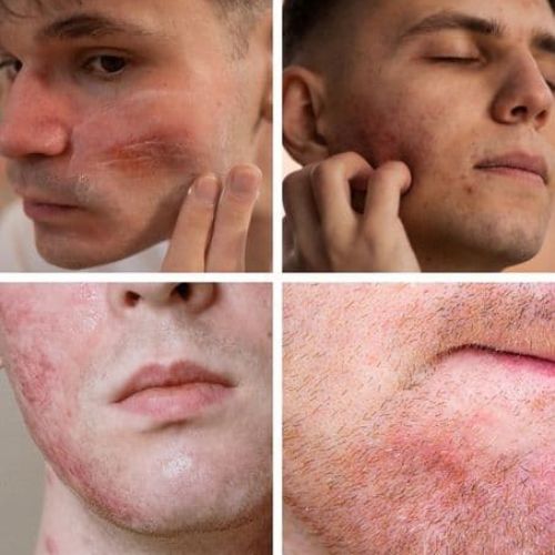 cross section of weather and heating related skin issues on the beard area of the face