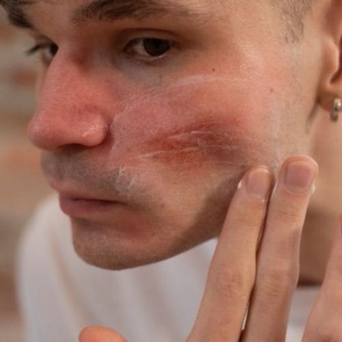 young man treating skin with topical medication