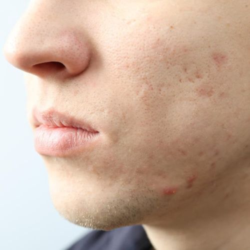 young man with no facial hair, has pitted skin from acne scars on left side of his face