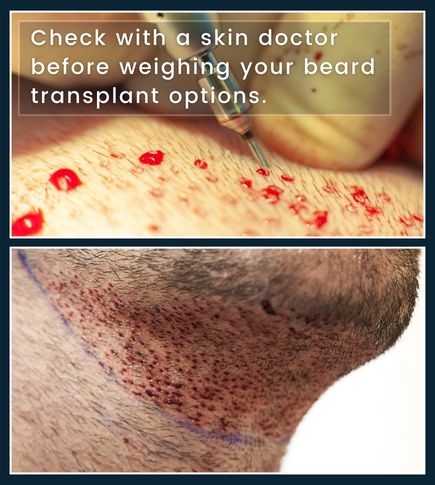 cross section infographic. close up of transplant procedure and a man after beard transplant procedure with visible scars