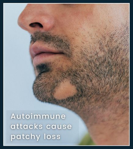 A man with a patchy beard due to alopecia, highlighting random bald spots caused by autoimmune conditions.