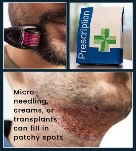 Infographic-style illustration showing icons for micro-needling, a skin cream jar, and a beard transplant next to a man with a patchy beard, symbolizing options for fixing scars and uneven hair growth.