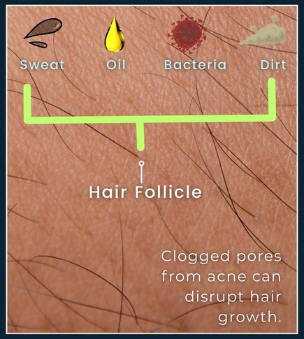 Infographic illustration of a close-up view of skin showing pores and a hair follicle blocked by dead skin, oil, and bacteria, explaining how acne starts.