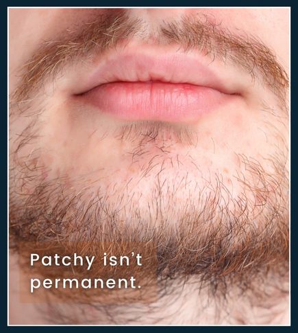 Man checking his beard in a mirror, with visual cues suggesting that patchy beard growth may improve over time
