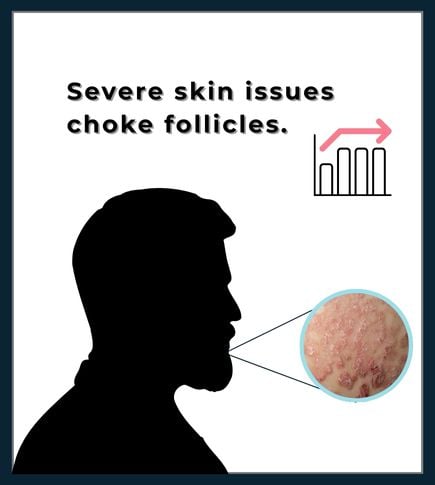 Close-up of a man's beard area with flaky, inflamed skin, illustrating how chronic skin conditions can block hair follicles.