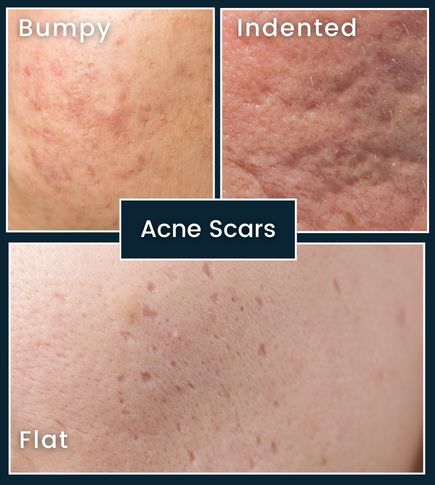 Infographic-style cross-section of skin showing areas with acne damage and different types of scars, illustrating how the body repairs itself.