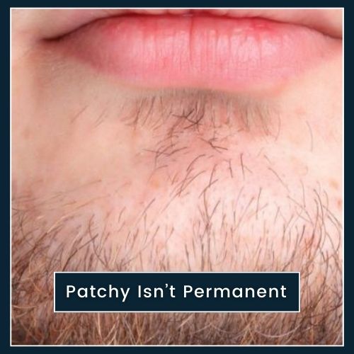 close up of a man's chin with sparse, patchy facial hair