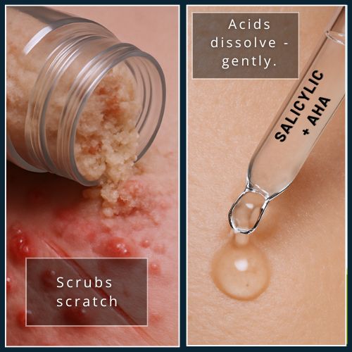 Split photo showing coarse scrub scratching red, irritated skin on the left and a clear salicylic–AHA droplet gently dissolving dead cells on smooth skin on the right.