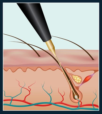 Closs up medical illustration showing a Cross section of Electrolysis probe disabling hair follicle at the root