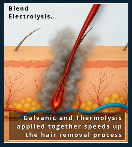 Illustrating the blend electrolyis method where both the galvanic and thermolysis methods are applied at the same time for faster hair removal