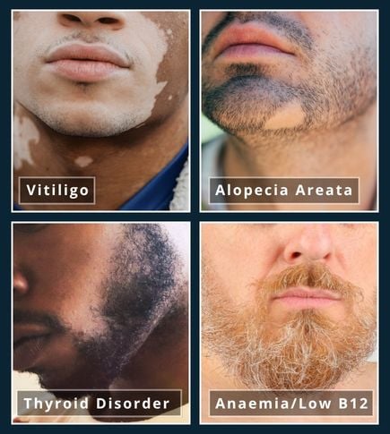 4-image collage of beard close-ups illustrating health conditions including Thyroid Disorders, Anaemia / Low B12, Alopecia Areata, Vitiligo