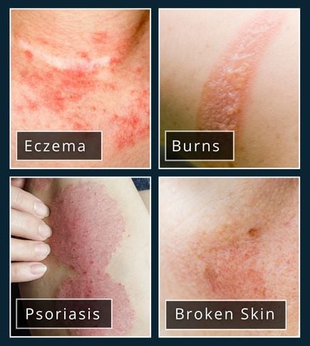 four image collage of skin conditions that should avoid hair removal creams