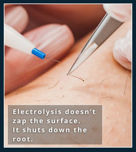 Electrolysis probe targeting hair follicle for permanent removal