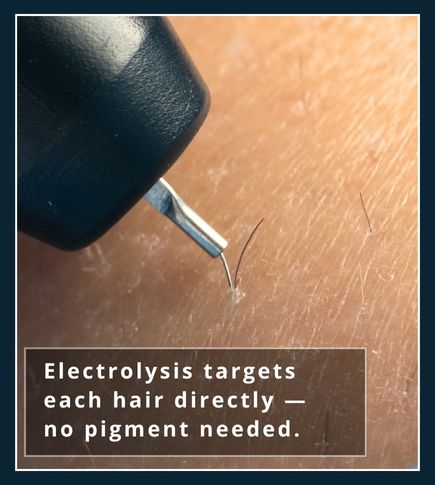 Electrolysis probe targeting hair follicle for permanent removal