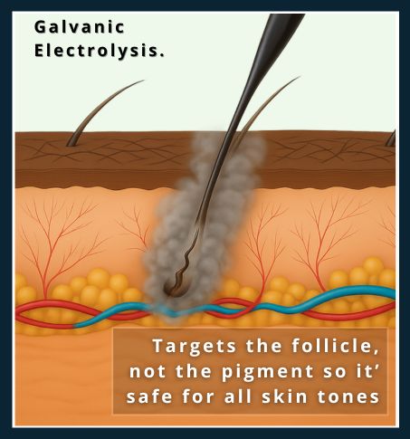 a stylised medical cross section of a galvanic electrolysis probe being used on richly-pigmented skin - showing precision hair removal technique
