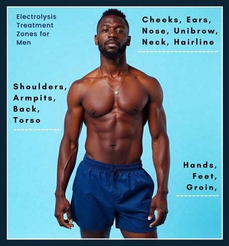 Illustration showing typical electrolysis areas for men including neckline, cheeks, back, shoulders, ears and nose, with sensitive zones excluded for clarity.