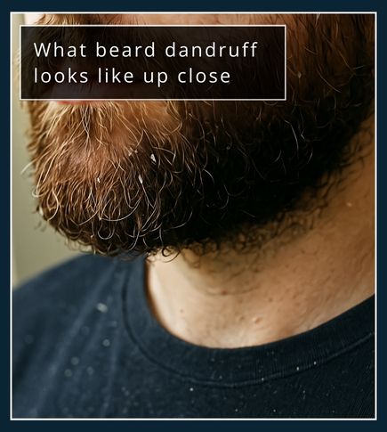 Close-up of a man’s beard with visible white or yellow dandruff flakes.