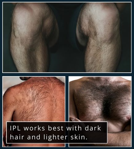 Two stacked images showing light and medium skin tones with dark coarse hair on legs and chest.