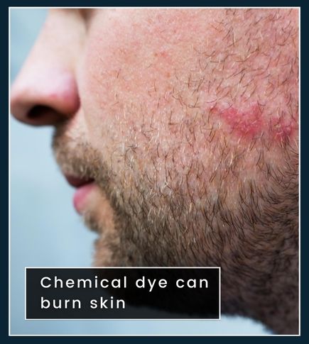 Redness and irritation on a man’s beard area caused by chemical beard dye with PPD.