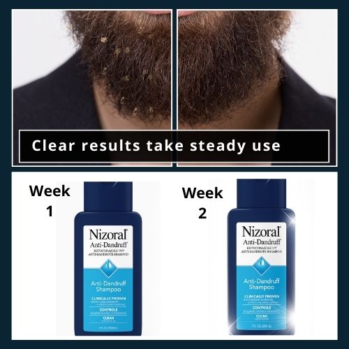 Nizoral 1% shampoo bottle shown over a one to two week timeline to suggest results.