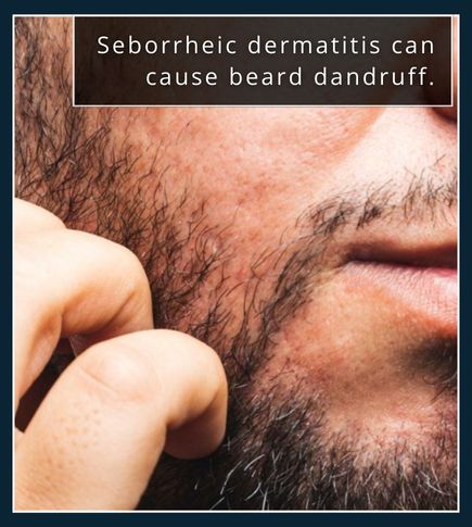 Close-up of a beard with mild redness and oily dandruff flakes caused by seborrheic dermatitis.