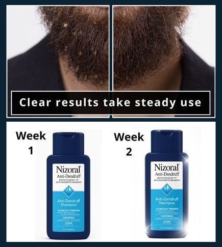 Nizoral 1% shampoo bottle shown over a one to two week timeline to suggest results.