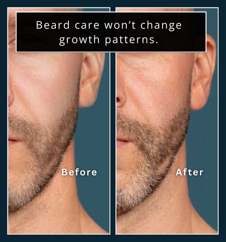 Before-and-after images of a beard showing improved health but the same patchy area.