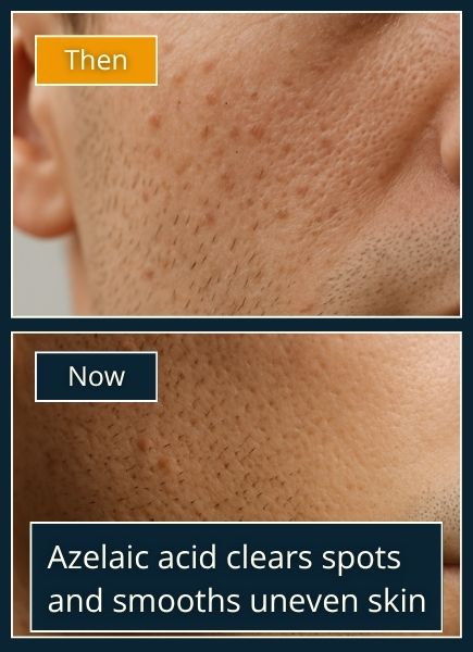 Realistic male skin portrait showing side-by-side contrast between oily and clear texture, illustrating azelaic acid’s balancing effect.