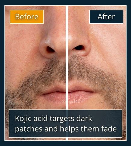Realistic portrait showing before-and-after balance of male skin tone, symbolising kojic acid’s brightening effect on dark spots.
