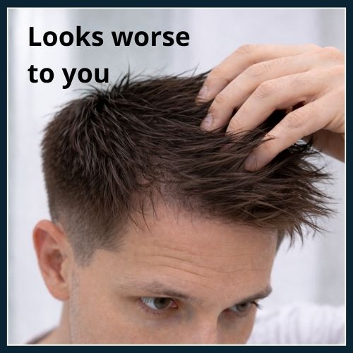 Close-up of a man in his early 30s. He has slight recession at temples one hand is lightly touching his hairline.