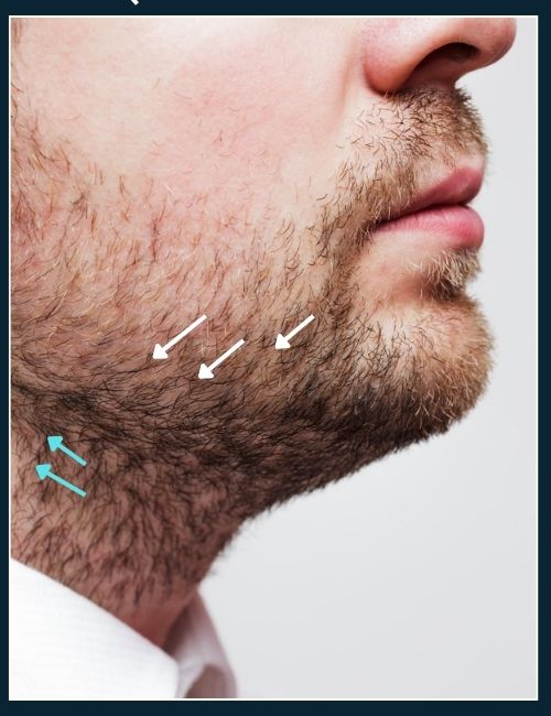 small arrows show direction change of hair growth on mans cheek, jawline and neck